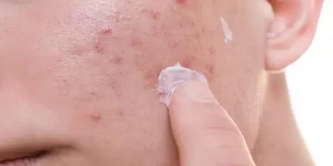 حبوب الوجه ،أسبابها وطرق الإزالة و العلاج