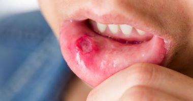 التهاب الفم: الأسباب والعلاج