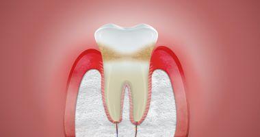 علاج التهاب اللثة والأسنان في المنزل