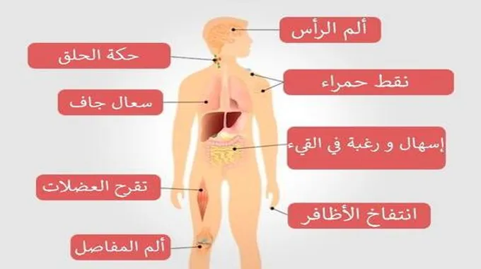 مرض السيدا أسبابه واعراضه وعلاجه