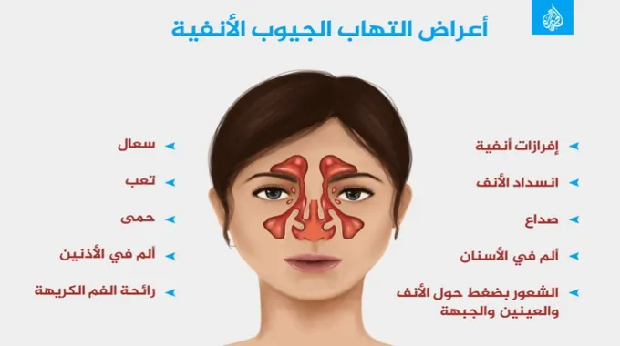 أسباب وأعراض صداع الجيوب الأنفية