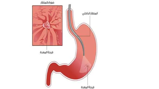 أعراض وعلاج قرحة المعدة