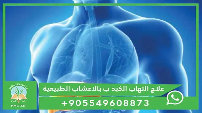 علاج فعال لقرحة المعدة بالأعشاب الطبيعية