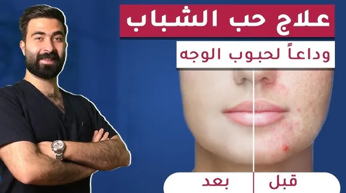 وداعًا لحبوب الوجه: حلول طبيعية مذهلة!